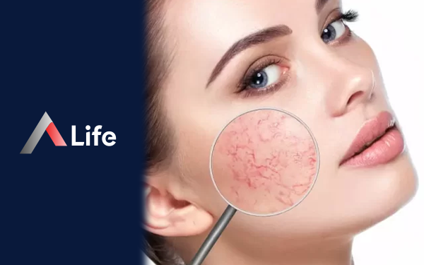 Roza Hastalığı Nedir? Belirti ve Tedavileri Nelerdir?
