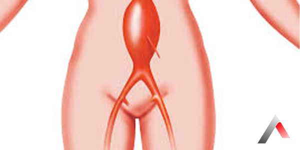 Abdominal_Aort_Anevrizmas___2de8f314.webp