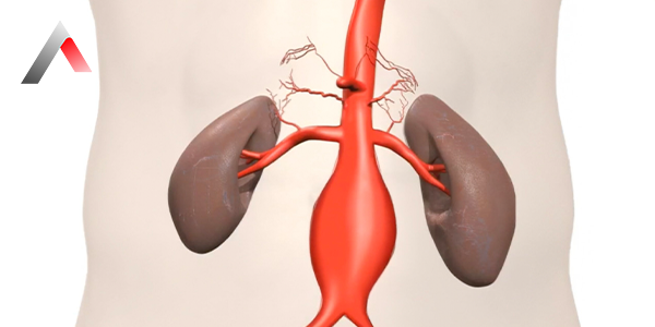 Abdominal_Aort_Anevrizmas___Nedir_23409795.webp