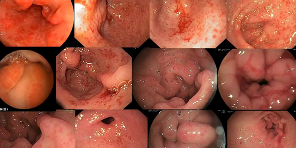 Antral_Gastrit_60be9684.webp