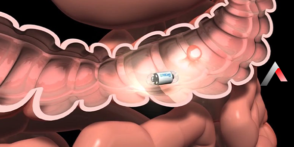 Capsule_endoscopy_166a55c0.webp