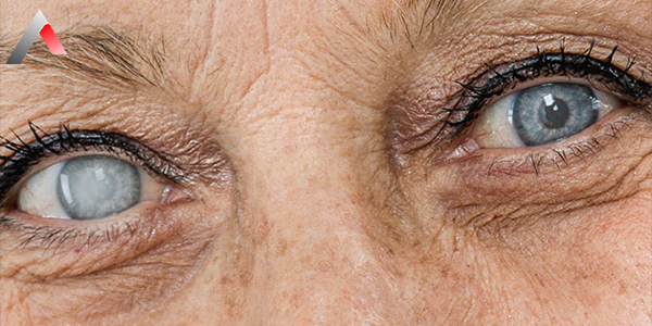 Cataract_fc406ecd.webp