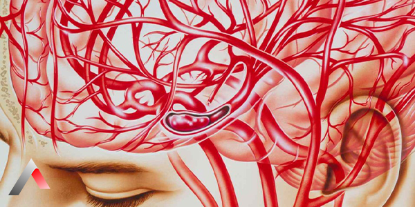 Cerebral_Angiography_11be0f55.webp