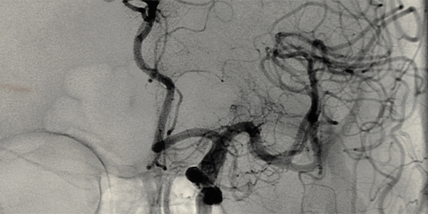 Cerebral_Angiography_258a05e3.webp