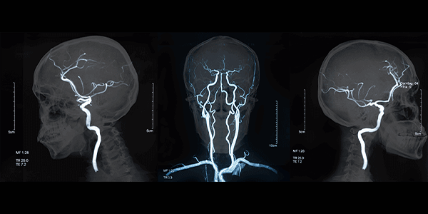 Cerebral_Angiography_89648f05.webp