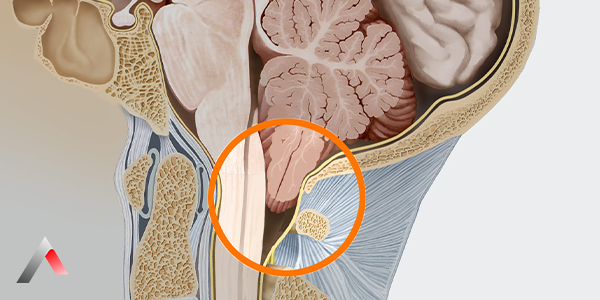 Chiari_Malformasyonu_T__rleri_7c57240d.webp