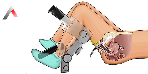 Colposcopy._3205e3b9.webp