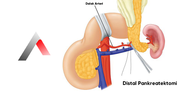 Distal_Pankreatektomi_e7b8e8da.webp