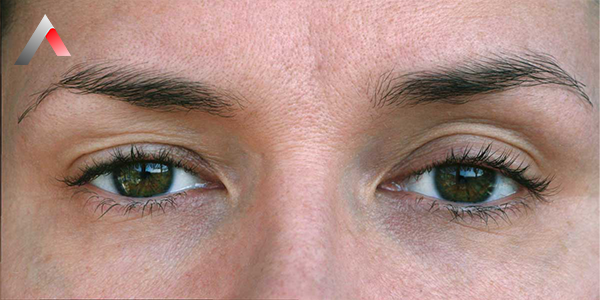 Drooping_Eyelid__Ptosis__Surgery_1e685b1e.webp