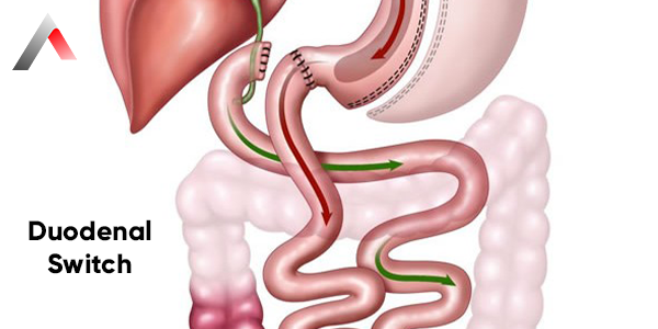 Duodenal_Switch_7e51eb3b.webp