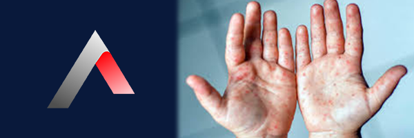 El_Ayak_Hastal_______Nedir_ab75f150.webp