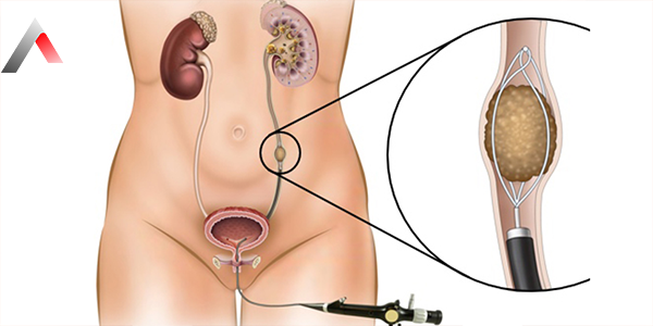 Endoscopic_Ureteral_Stone_Treatment_with_Flexible_Laser_8445d4e8.webp