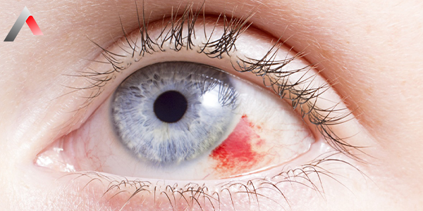 Eye_Injuries_cf2e688f.webp