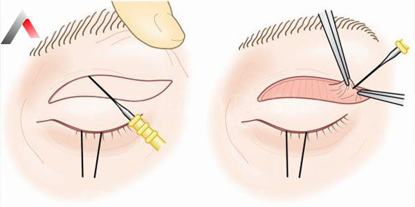 Eyelid_Combination_Surgeries._fa21e5c2.webp