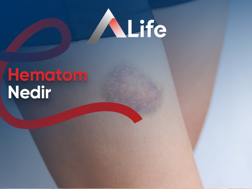 Hematom Nedir?