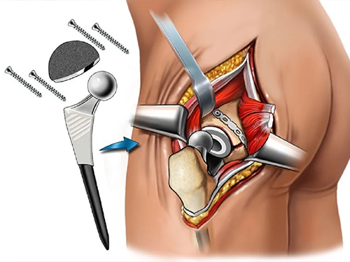 Hip_Prosthesis_Surgery_69cb87ac.webp