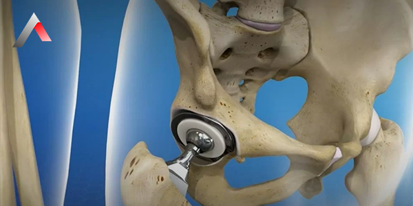 Hip_Prosthesis_bb4ee343.webp