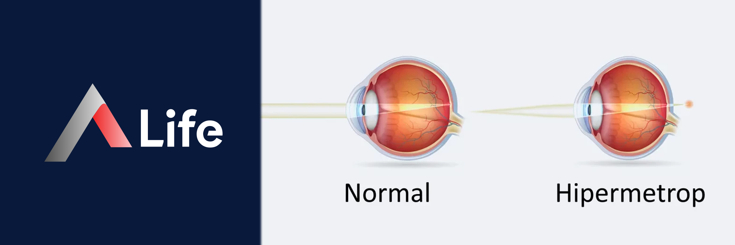 Hipermetropi_c46f9b1d.webp