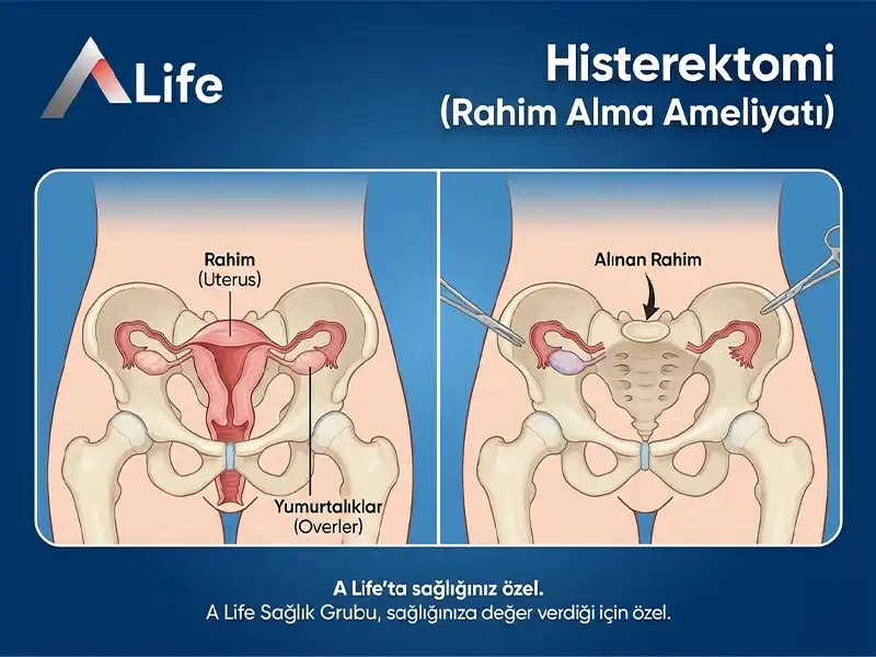 Histerektomi Nedir?