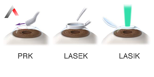 LASEK__Laser_Epithelial_Keratomileusis__b559ff97.webp