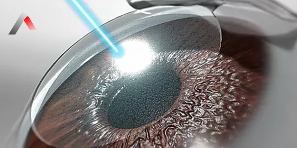 LASIK__Laser-Assisted_In_Situ_Keratomileusis__3bbe22c8.webp