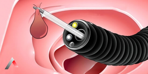 Lower_Endoscopy__Colonoscopy__74343ca4.webp