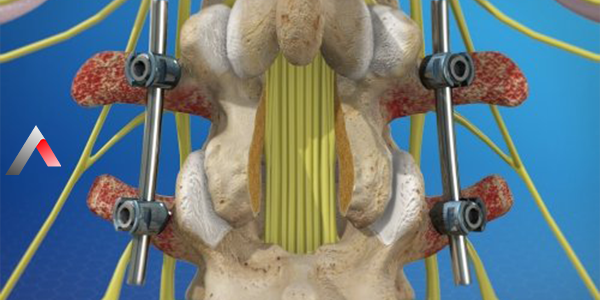 Lumbar_Spinal_Fusion_c60a7b10.webp