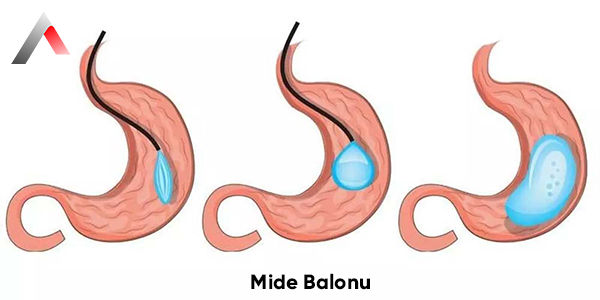 Mide_Balonu_567d98c8.webp
