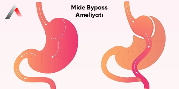 Mide_Bypass_Ameliyat___3404f324.webp