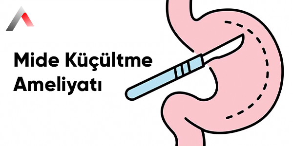 Mide_K______ltme_Ameliyat___988673cb.webp