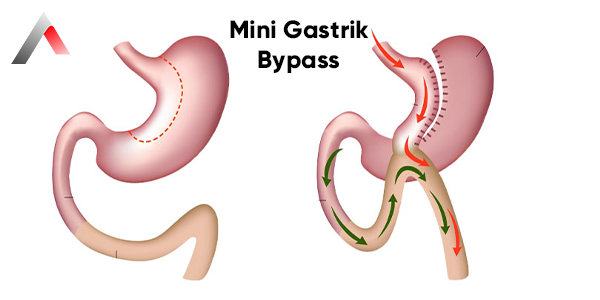 Mini_Gastrik_Bypass_9a077f3b.webp