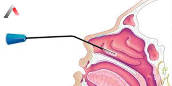 Nasal_Polyp_Ablation_Surgery_dd56e03b.webp