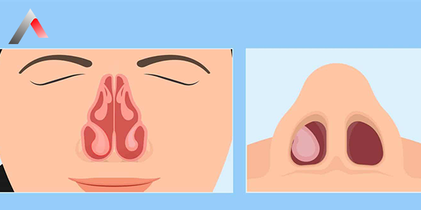 Nasal_Polyp_Enlargement_61bd2704.webp