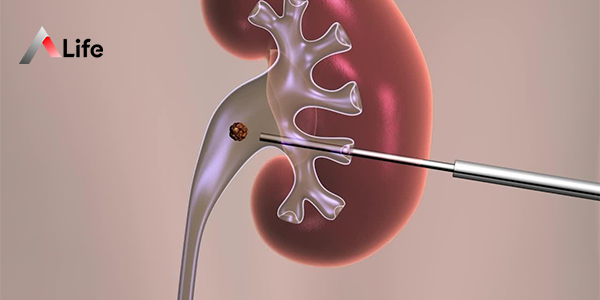 Nephrolithotomy_08ac43d7.webp