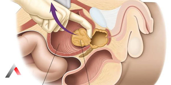 Open_Prostate_Surgery-_0d97f340.webp