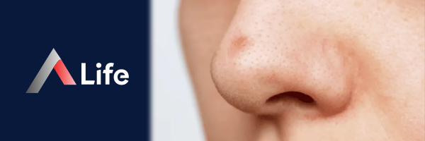 Pimple_on_the_Nose_d52419b4.webp