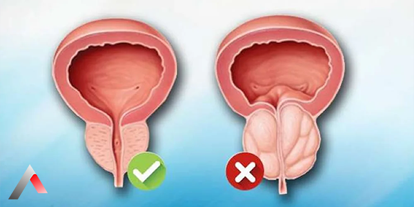 Prostate_Enlargement_a28dd334.webp
