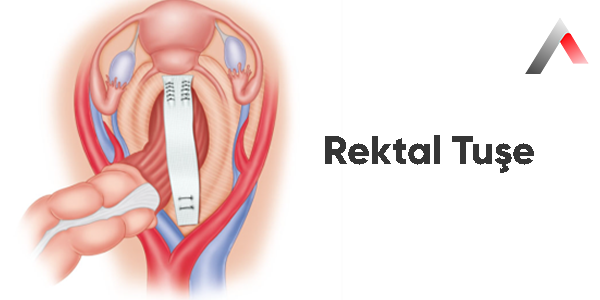 Rektal_Tu__e_de4a863c.webp