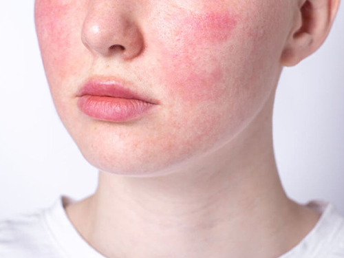 Rosacea_Telenjiektazileri_db88481b.webp