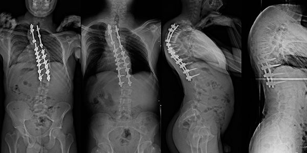 Scoliosis_Surgery_e6326025.webp