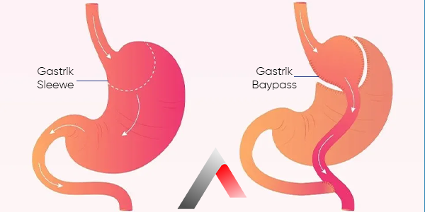 Sleeve_gastrectomy_a4f47e7e.webp