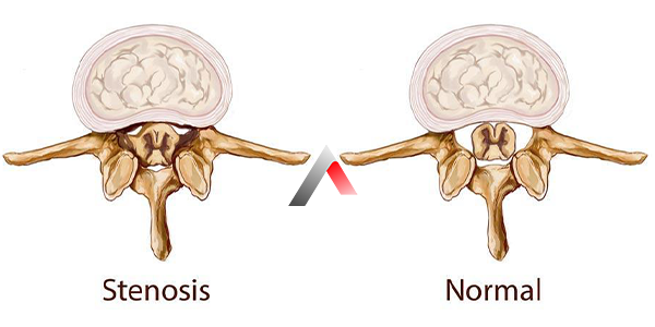 Spinal_Stenoz_Nedir_ed0b88ca.webp