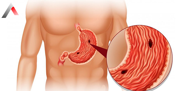 Stomach_Ulcer_abb31366.webp