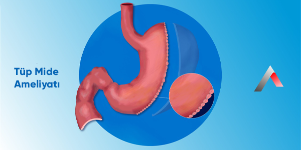 T__p_Mide_Ameliyat___12cccdab.webp