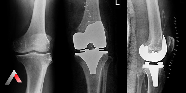 Total_Knee_Replacement_Surgery_ec72679c.webp