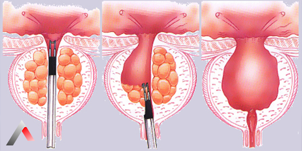 Transurethral_Resection__TURP_-_5db03948.webp
