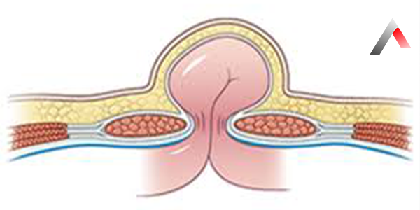 Umbilical_Hernia_24b28c3b.webp