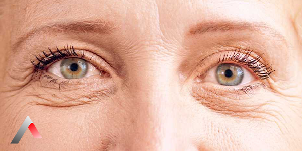 Upper_Eyelid_Sagging_5dbabf99.webp