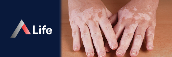 Vitiligo_2fc5dd67.webp