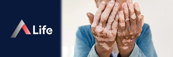 Vitiligo_Nedir_609e4c1f.webp